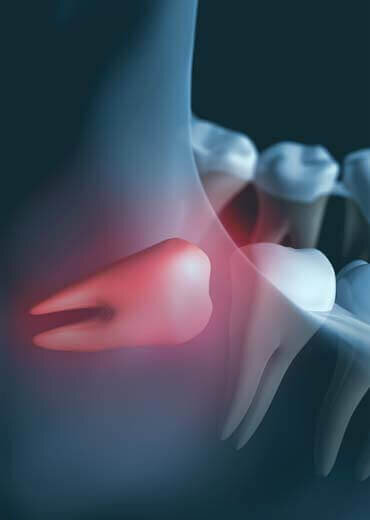 Wisdom Tooth Removal Wisdom Tooth Removal